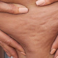 La cellulite vous complexe depuis des années ?